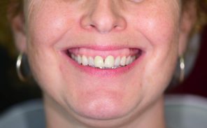 Before - Wiltondental